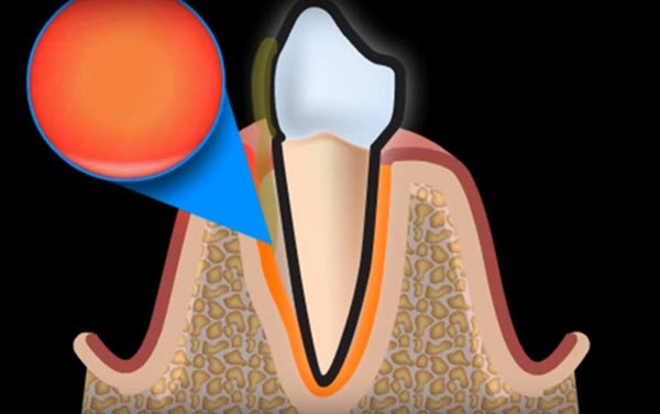 Periodontal disease - how to treat gum inflammation!